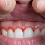 Close-up view of upper teeth and gums with visible redness along the gumline